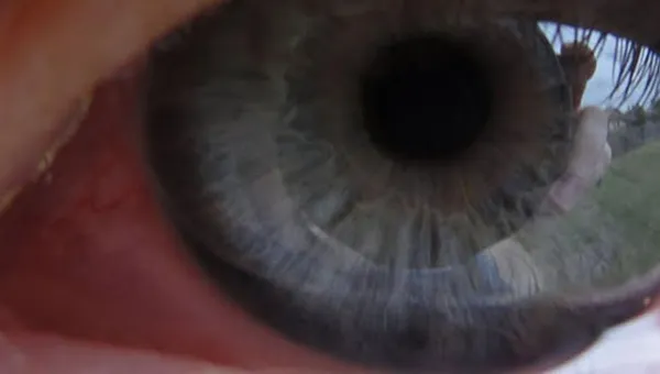 What Is A Pterygium?