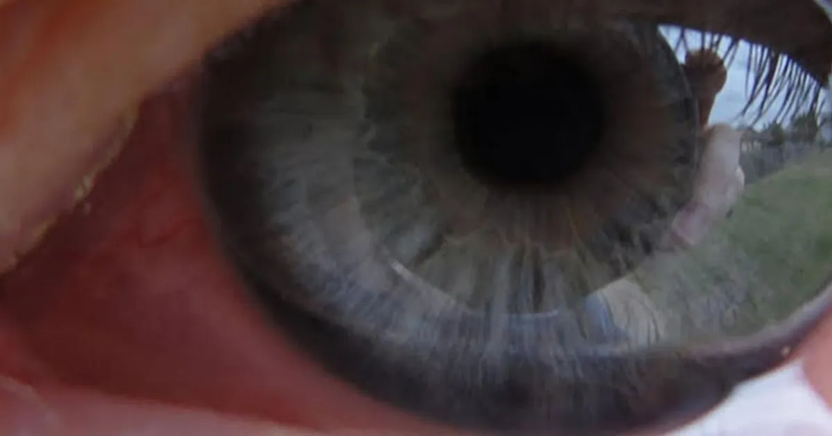 What Is A Pterygium?