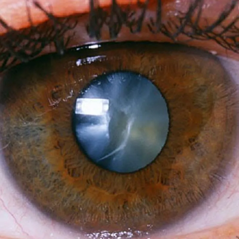 A close-up of an eye with a cloudy cataract in the pupil