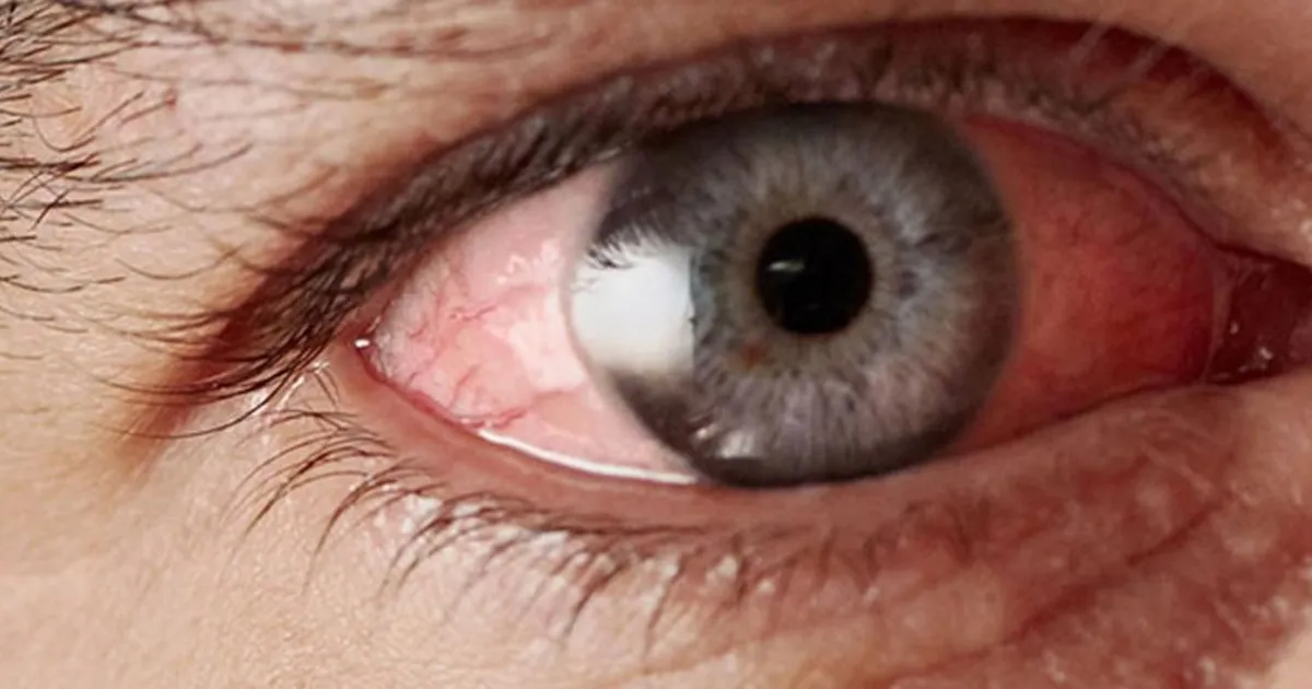 What Is Astigmatism?