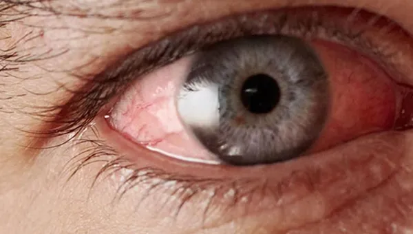 What Is Astigmatism?