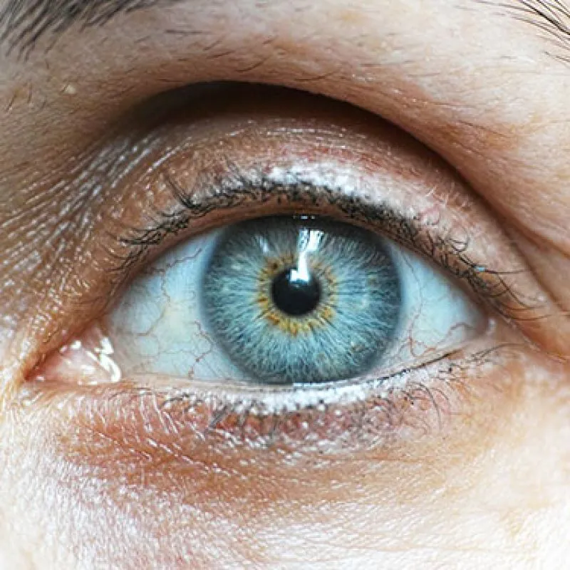 A close-up of a red, bloodshot eye