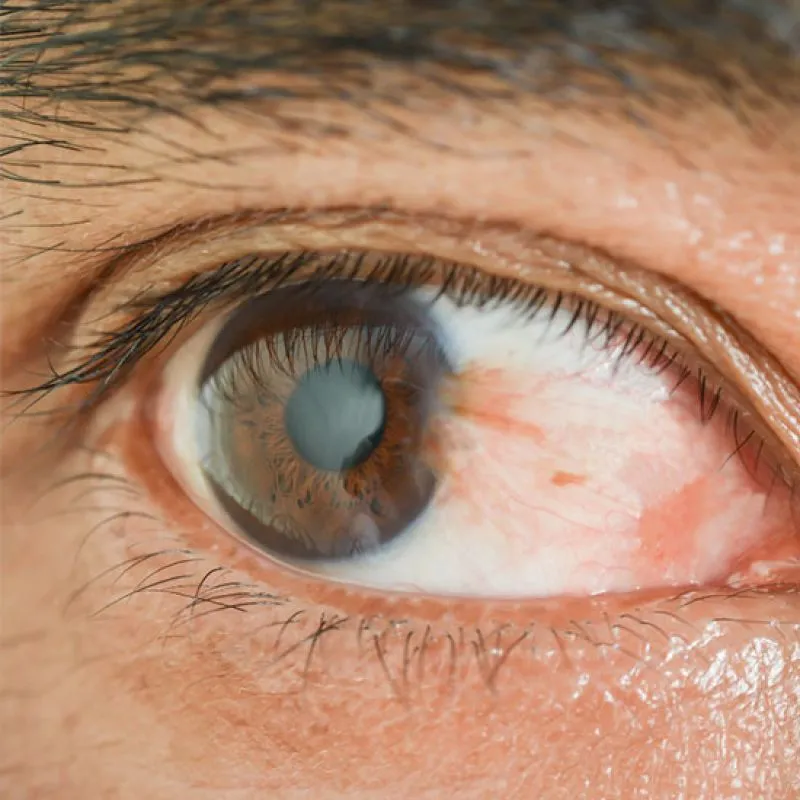 A close-up of an eye with a pterygium growing across the white